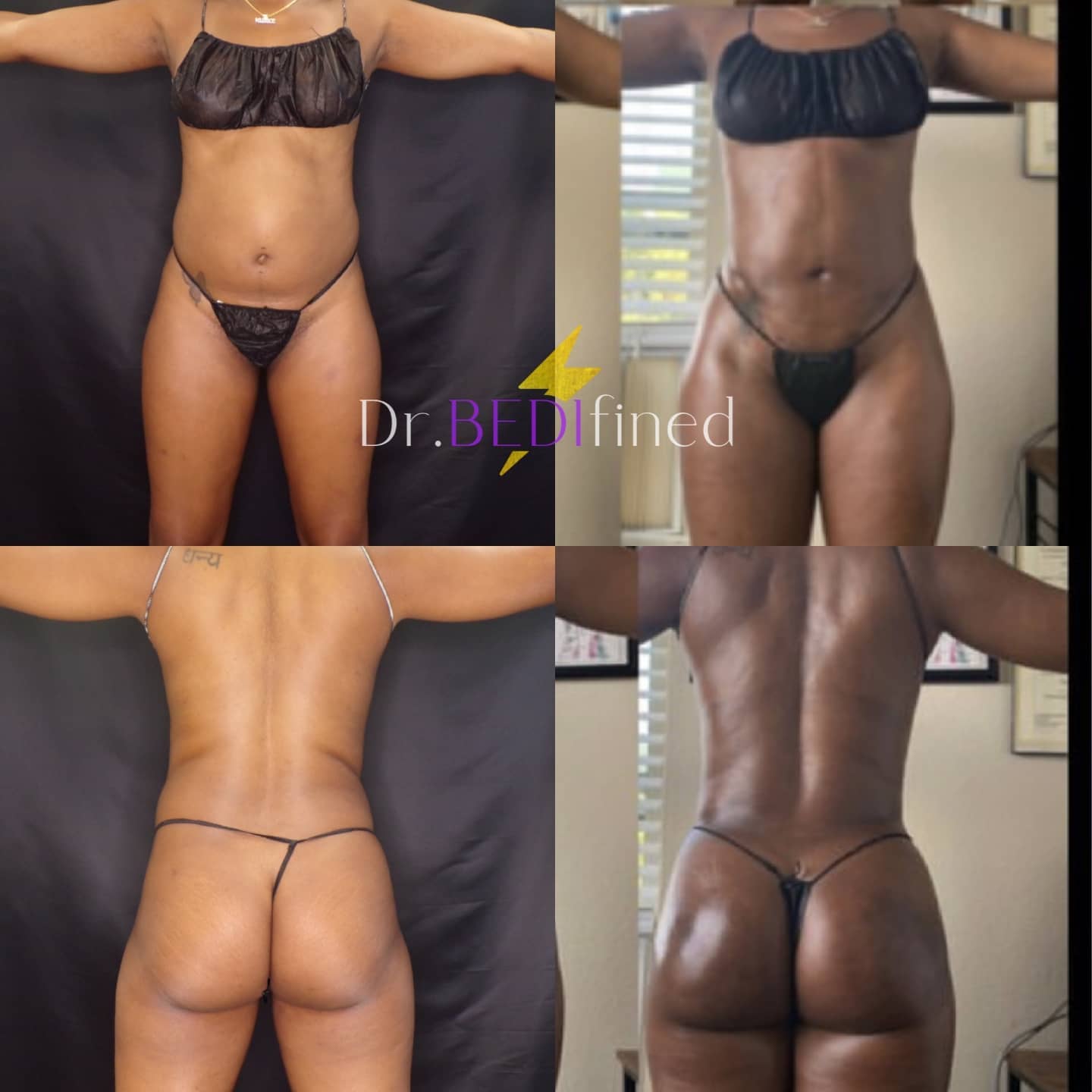 Before & After Brazilian Butt Lift (BBL) Photos