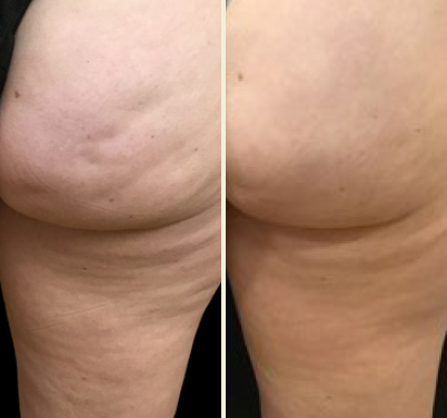 Cellulite Treatments - Before & After Images - The Private Clinic